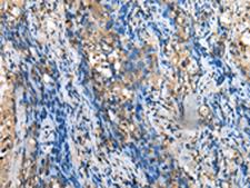 MOB4 / PHOCN Antibody - Immunohistochemistry of paraffin-embedded Human lung cancer tissue  using MOB4 Polyclonal Antibody at dilution of 1:35(×200)