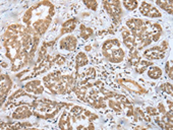 MOB4 / PHOCN Antibody - Immunohistochemistry of paraffin-embedded Human esophagus cancer tissue  using MOB4 Polyclonal Antibody at dilution of 1:35(×200)