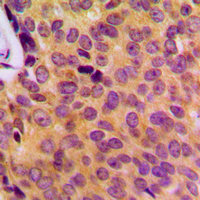 MOBKL2B / MOB3B Antibody - Immunohistochemical analysis of MOB3B staining in human breast cancer formalin fixed paraffin embedded tissue section. The section was pre-treated using heat mediated antigen retrieval with sodium citrate buffer (pH 6.0). The section was then incubated with the antibody at room temperature and detected using an HRP conjugated compact polymer system. DAB was used as the chromogen. The section was then counterstained with hematoxylin and mounted with DPX.