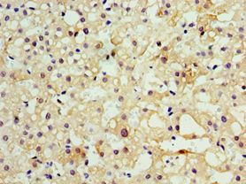 MOG Antibody - Immunohistochemistry of paraffin-embedded human liver cancer using antibody at 1:100 dilution.