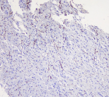 MOG Antibody - IHC staining of FFPE human glioma with MOG antibody at 1ug/ml. HIER: boil tissue sections in pH6, 10mM citrate buffer, for 10-20 min followed by cooling at RT for 20 min.