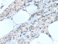 MOG Antibody - Immunohistochemistry of paraffin-embedded Human breast cancer tissue  using MOG Polyclonal Antibody at dilution of 1:25(×200)