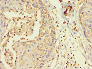 MORC1 Antibody - Immunohistochemistry of paraffin-embedded human cervical cancer at dilution 1:100
