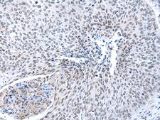 MORC2 Antibody - Immunohistochemistry of paraffin-embedded Human lung cancer tissue  using MORC2 Polyclonal Antibody at dilution of 1:25(×200)