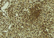 MORF / MYST4 Antibody - 1:100 staining human breast carcinoma tissue by IHC-P. The sample was formaldehyde fixed and a heat mediated antigen retrieval step in citrate buffer was performed. The sample was then blocked and incubated with the antibody for 1.5 hours at 22°C. An HRP conjugated goat anti-rabbit antibody was used as the secondary.