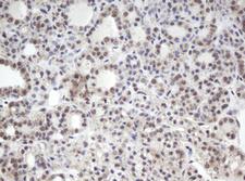 MORF4 Antibody - IHC of paraffin-embedded Carcinoma of Human thyroid tissue using anti-MORF4 mouse monoclonal antibody.