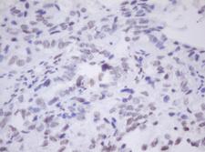 MORF4 Antibody - IHC of paraffin-embedded Adenocarcinoma of Human ovary tissue using anti-MORF4 mouse monoclonal antibody.