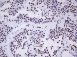 MORF4 Antibody - IHC of paraffin-embedded Carcinoma of Human pancreas tissue using anti-MORF4 mouse monoclonal antibody.