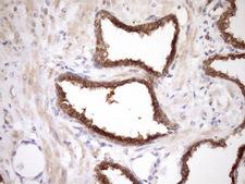 MORF4L1 / MRG15 Antibody - Immunohistochemical staining of paraffin-embedded Carcinoma of Human prostate tissue using anti-MORF4L1 mouse monoclonal antibody. (Heat-induced epitope retrieval by Tris-EDTA, pH8.0)(1:150)