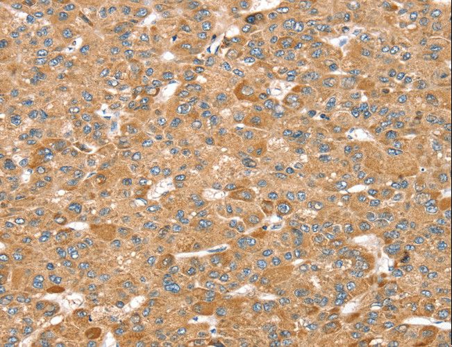 MORF4L1 / MRG15 Antibody - Immunohistochemistry of paraffin-embedded Human liver cancer using MORF4L1 Polyclonal Antibody at dilution of 1:35.
