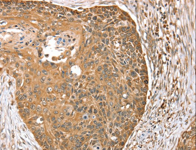 MORF4L1 / MRG15 Antibody - Immunohistochemistry of paraffin-embedded Human esophagus cancer using MORF4L1 Polyclonal Antibody at dilution of 1:35.