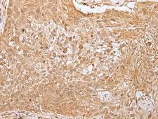 MORF4L1 / MRG15 Antibody - Immunohistochemistry of paraffin-embedded Human lung cancer tissue  using MORF4L1 Polyclonal Antibody at dilution of 1:30(×200)