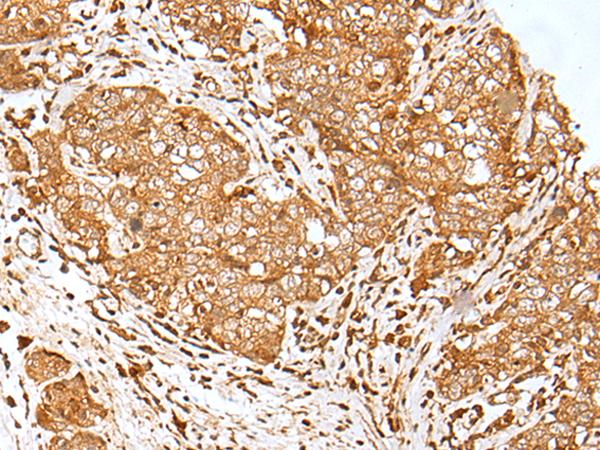 MORF4L1 / MRG15 Antibody - Immunohistochemistry of paraffin-embedded Human esophagus cancer tissue  using MORF4L1 Polyclonal Antibody at dilution of 1:30(×200)