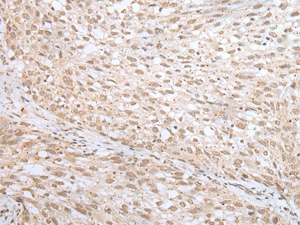 MORF4L1 / MRG15 Antibody - Immunohistochemistry of paraffin-embedded Human lung cancer tissue  using MORF4L1 Polyclonal Antibody at dilution of 1:45(×200)