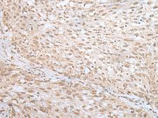 MORF4L1 / MRG15 Antibody - Immunohistochemistry of paraffin-embedded Human lung cancer tissue  using MORF4L1 Polyclonal Antibody at dilution of 1:45(×200)