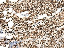 MORF4L2 / MRGX Antibody - Immunohistochemistry of paraffin-embedded Human lung cancer tissue  using MORF4L2 Polyclonal Antibody at dilution of 1:25(×200)