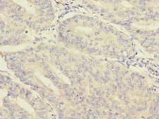 MORN5 Antibody - Immunohistochemistry of paraffin-embedded human endometrial cancer using MORN5 Antibody at dilution of 1:100