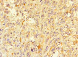 MORN5 Antibody - Immunohistochemistry of paraffin-embedded human melanoma using MORN5 Antibody at dilution of 1:100