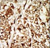 MOS Antibody - Formalin-fixed and paraffin-embedded human cancer tissue reacted with the primary antibody, which was peroxidase-conjugated to the secondary antibody, followed by AEC staining. This data demonstrates the use of this antibody for immunohistochemistry; clinical relevance has not been evaluated. BC = breast carcinoma; HC = hepatocarcinoma.