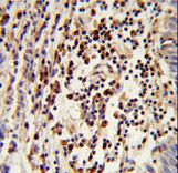 MOSC2 Antibody - Formalin-fixed and paraffin-embedded human lung carcinoma reacted with MOSC2 Antibody , which was peroxidase-conjugated to the secondary antibody, followed by DAB staining. This data demonstrates the use of this antibody for immunohistochemistry; clinical relevance has not been evaluated.