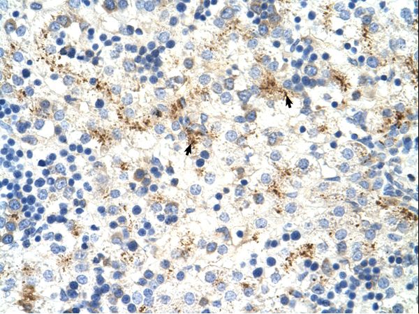 MOV10 Antibody - MOV10 antibody ARP36480_T100-NP_066014-MOV10(Mov10, Moloney leukemia virus 10, homolog (mouse)) Antibody was used in IHC to stain formalin-fixed, paraffin-embedded human liver.  This image was taken for the unconjugated form of this product. Other forms have not been tested.