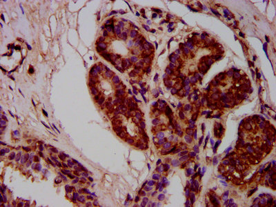 MOV10L1 Antibody - Immunohistochemistry Dilution at 1:400 and staining in paraffin-embedded human breast cancer performed on a Leica BondTM system. After dewaxing and hydration, antigen retrieval was mediated by high pressure in a citrate buffer (pH 6.0). Section was blocked with 10% normal Goat serum 30min at RT. Then primary antibody (1% BSA) was incubated at 4°C overnight. The primary is detected by a biotinylated Secondary antibody and visualized using an HRP conjugated SP system.