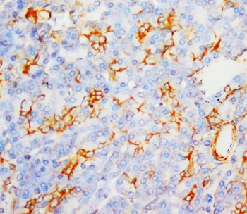 MPO / Myeloperoxidase Antibody - IHC-P: Myeloperoxidase antibody testing of human liver cancer tissue