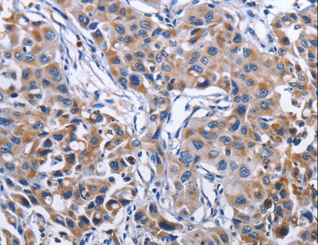 MPO / Myeloperoxidase Antibody - Immunohistochemistry of paraffin-embedded Human lung cancer using MPO Polyclonal Antibody at dilution of 1:50.