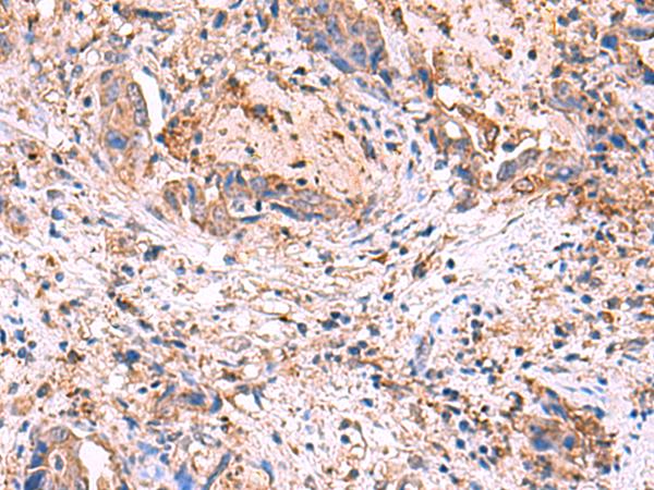 MPP1 Antibody - Immunohistochemistry of paraffin-embedded Human cervical cancer tissue  using MPP1 Polyclonal Antibody at dilution of 1:50(×200)