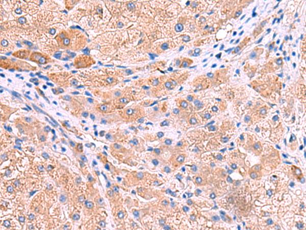 MPP1 Antibody - Immunohistochemistry of paraffin-embedded Human liver cancer tissue  using MPP1 Polyclonal Antibody at dilution of 1:50(×200)