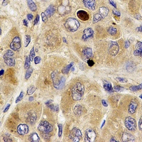 MPP2 Antibody - Immunohistochemical analysis of MPP2 staining in human liver cancer formalin fixed paraffin embedded tissue section. The section was pre-treated using heat mediated antigen retrieval with sodium citrate buffer (pH 6.0). The section was then incubated with the antibody at room temperature and detected using an HRP conjugated compact polymer system. DAB was used as the chromogen. The section was then counterstained with hematoxylin and mounted with DPX.