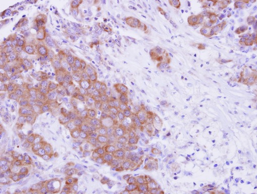 MPP3 Antibody - MPP3 antibody detects MPP3 protein at cytosol on Breast Carcinoma by immunohistochemical analysis. Sample: Paraffin-embedded Breast Carcinoma. MPP3 antibody dilution:1:500.