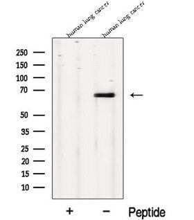 MPP3 Antibody - Western blot analysis of extracts of human lung carcinoma tissue using MPP3 antibody. The lane on the left was treated with blocking peptide.