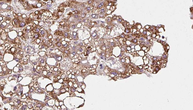 MPP5 Antibody - 1:100 staining human liver carcinoma tissues by IHC-P. The sample was formaldehyde fixed and a heat mediated antigen retrieval step in citrate buffer was performed. The sample was then blocked and incubated with the antibody for 1.5 hours at 22°C. An HRP conjugated goat anti-rabbit antibody was used as the secondary.