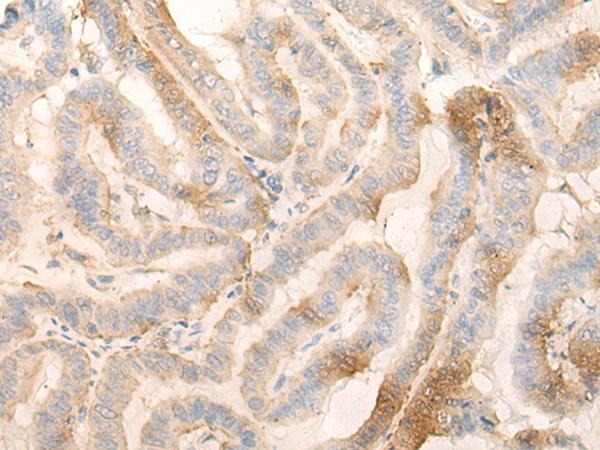MPPED2 Antibody - Immunohistochemistry of paraffin-embedded Human thyroid cancer tissue  using MPPED2 Polyclonal Antibody at dilution of 1:30(×200)