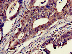 MPS1 / TTK Antibody - Immunohistochemistry of paraffin-embedded human colon cancer at dilution of 1:100