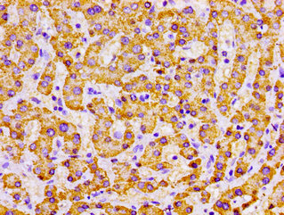 MPST Antibody - Immunohistochemistry image of paraffin-embedded human liver cancer at a dilution of 1:100