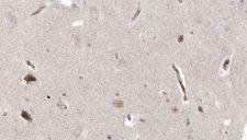 MPV17 Antibody - 1:100 staining human brain carcinoma tissue by IHC-P. The sample was formaldehyde fixed and a heat mediated antigen retrieval step in citrate buffer was performed. The sample was then blocked and incubated with the antibody for 1.5 hours at 22°C. An HRP conjugated goat anti-rabbit antibody was used as the secondary.