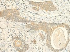 MPV17 Antibody - Immunohistochemistry of paraffin-embedded Human esophagus cancer tissue  using MPV17 Polyclonal Antibody at dilution of 1:50(×200)