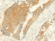 MPV17 Antibody - Immunohistochemistry of paraffin-embedded Human colorectal cancer tissue  using MPV17 Polyclonal Antibody at dilution of 1:50(×200)