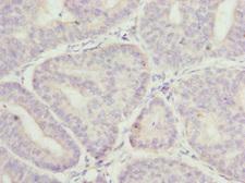 MR1 Antibody - Immunohistochemistry of paraffin-embedded human endometrial cancer at dilution 1:100