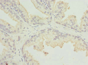 MR1 Antibody - Immunohistochemistry of paraffin-embedded human prostate cancer at dilution 1:100