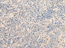MR1 Antibody - Immunohistochemistry of paraffin-embedded Human cervical cancer tissue  using MR1 Polyclonal Antibody at dilution of 1:40(×200)