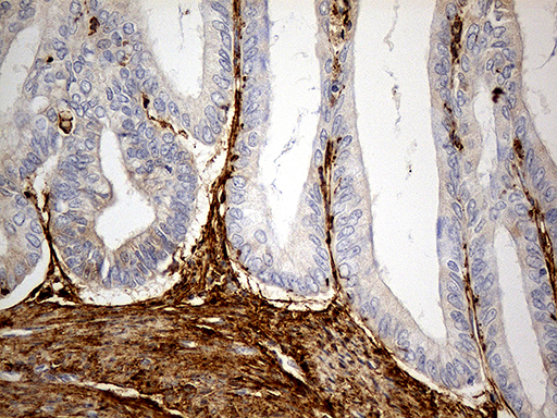 MRC2 / Endo180 Antibody - Immunohistochemical staining of paraffin-embedded Adenocarcinoma of Human endometrium tissue using anti-MRC2 mouse monoclonal antibody. (Heat-induced epitope retrieval by 1mM EDTA in 10mM Tris buffer. (pH8.5) at 120°C for 3 min. (1:5000)