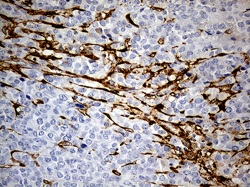 MRC2 / Endo180 Antibody - Immunohistochemical staining of paraffin-embedded Adenocarcinoma of Human breast tissue tissue using anti-MRC2 mouse monoclonal antibody. (Heat-induced epitope retrieval by 1mM EDTA in 10mM Tris buffer. (pH8.5) at 120°C for 3 min. (1:5000)