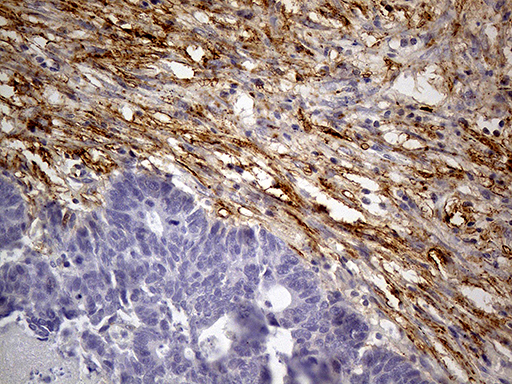 MRC2 / Endo180 Antibody - Immunohistochemical staining of paraffin-embedded Adenocarcinoma of Human colon tissue using anti-MRC2 mouse monoclonal antibody. (Heat-induced epitope retrieval by 1mM EDTA in 10mM Tris buffer. (pH8.5) at 120°C for 3 min. (1:5000)