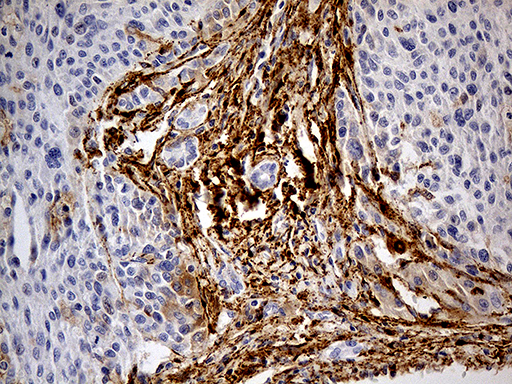 MRC2 / Endo180 Antibody - Immunohistochemical staining of paraffin-embedded Carcinoma of Human liver tissue using anti-MRC2 mouse monoclonal antibody. (Heat-induced epitope retrieval by 1mM EDTA in 10mM Tris buffer. (pH8.5) at 120°C for 3 min. (1:5000)