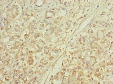 MRC2 / Endo180 Antibody - Immunohistochemistry of paraffin-embedded human pancreatic cancer at dilution 1:100