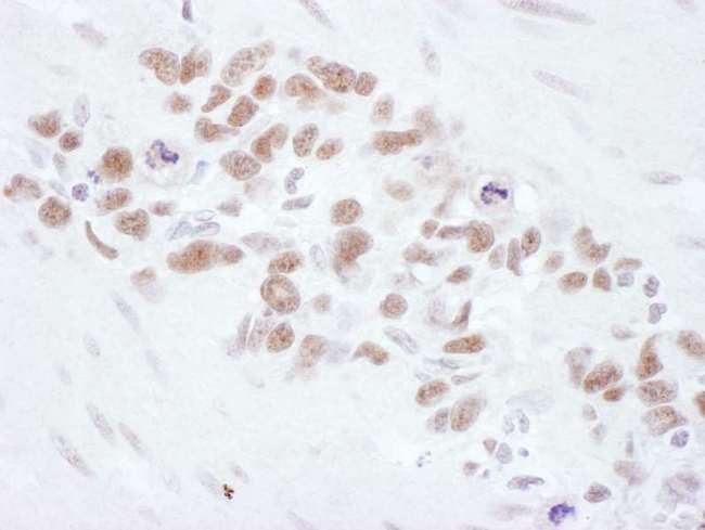 MRE11A / MRE11 Antibody - Detection of Human Mre11 by Immunohistochemistry. Sample: FFPE section of human stomach linitis plastica. Antibody: Affinity purified rabbit anti-Mre11 used at a dilution of 1:1000 (1 ug/ml). Detection: DAB.