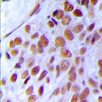 MRE11A / MRE11 Antibody - Immunohistochemical analysis of MRE11 staining in human breast cancer formalin fixed paraffin embedded tissue section. The section was pre-treated using heat mediated antigen retrieval with sodium citrate buffer (pH 6.0). The section was then incubated with the antibody at room temperature and detected using an HRP polymer system. DAB was used as the chromogen. The section was then counterstained with hematoxylin and mounted with DPX.